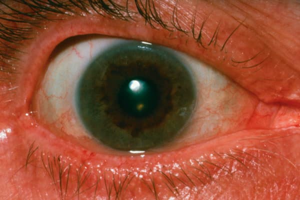 Nahaufnahme eines Auges mit Kayser-Fleischer-Kornealring