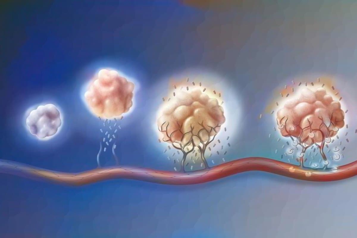 VEGFR-Inhibitoren wie Anlotinib sorgen dafür, dass die für die Tumorbildung notwendige Angiogenese gehemmt wird.
