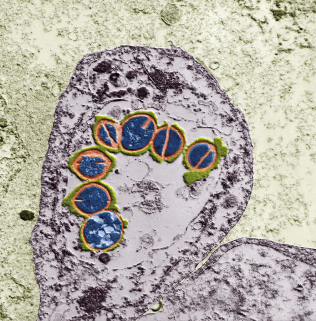 Streptokokken in menschlicher Lunge 20 000:1