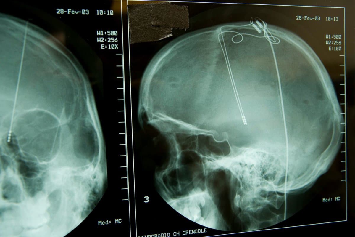Die Tiefe Hirnstimulation könnte künftig eine Option für Patienten mit Schädel-Hirn-Trauma sein.