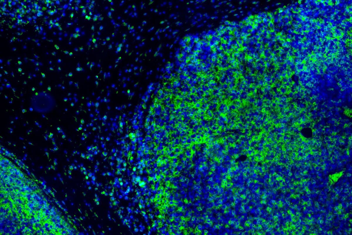 Immuntherapien wie Atezolizumab verstärken die Aktivität von T-Zellen im Tumor.