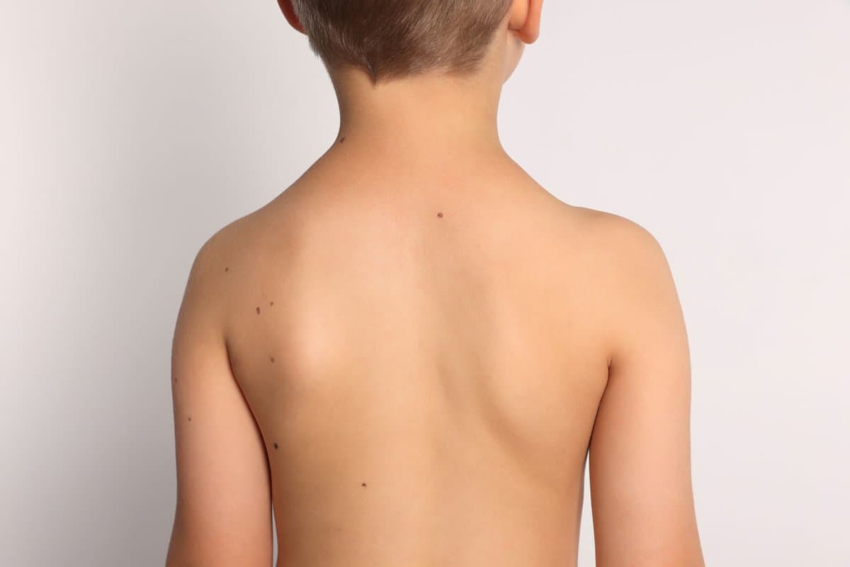 Maligne Melanome sind bei jungen Menschen zwar selten, haben aber häufig eine schlechte Prognose.