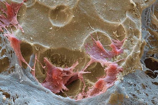 Rasterelektronenmikroskopische Aufnahme von Osteoklasten bei Osteoporose.