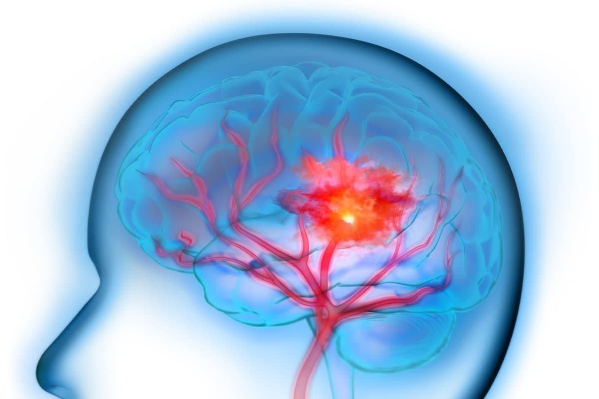 Tirofiban verbesserte das klinische Ergebnis beim Schlaganfall.