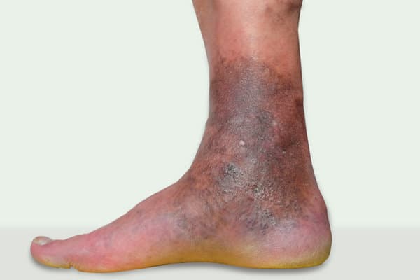 Nahaufnahme Fuss mit entzündete Areale mit nässenden Stellen, Bläschen und Krusten aufgrund Stauungsdermatitis.