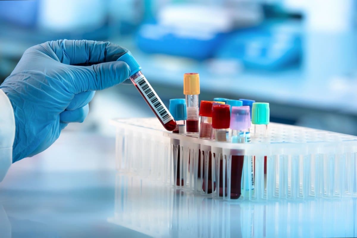 Im Blut von Patienten mit Post Covid gibt es mehrere Veränderungen.