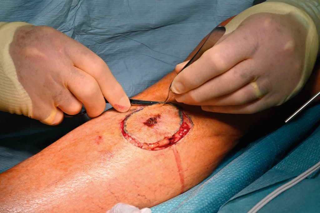 Surgeon excising squamous cell carcinoma (SCC) from the leg of an 80 year old male patient. This form of skin cancer arises from squamous cells, flat scale-like cells in the upper layers of the skin. The tumour forms interconnecting bands of keratinised cells that invade the surrounding tissue. Squamous cell carcinoma is the second most common form of skin cancer. Most cases arise from pre-cancero