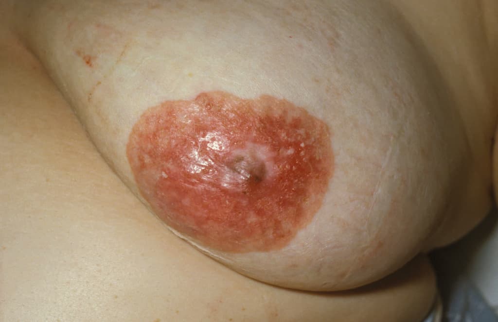 Paget's disease of the nipple. Cancerous nipple of a female patient with Paget's disease. This is a rare form of breast cancer (ductal carcinoma) in which the milk ducts of the nipple become cancerous. It causes flaking skin,itching and burning pain in the affected nipple,which may be mistaken for eczema. This cancer commonly spreads to the rest of the breast. If the cancer is diagnosed early,remo