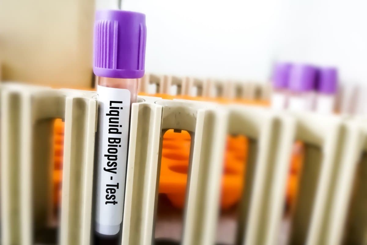 Ein positiver ctDNA-Befund nach Resektion spricht für eine schlechte Prognose.