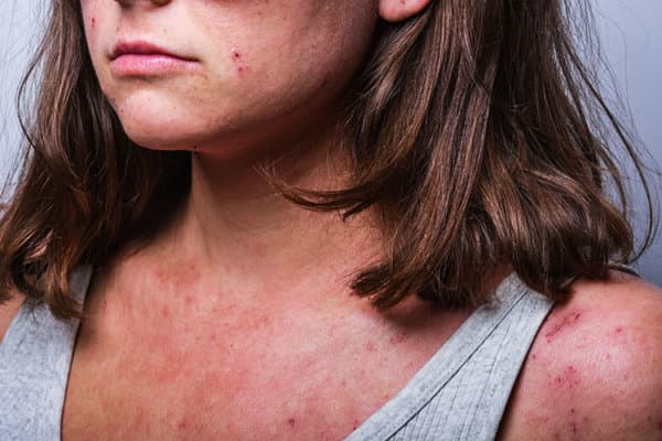 Les nouveaux traitements systémiques n’ont pas rendu les thérapies conventionnelles obsolètes en dermatite atopique.