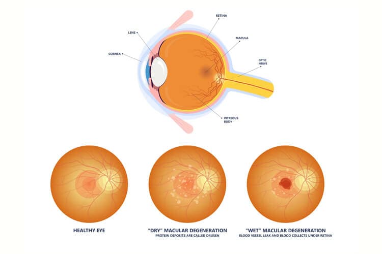Darstelllung Makuladegeneration