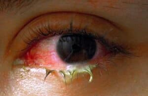 Für eine bakterielle Bindehautentzündung sprechen eitriges Sekret und morgendlich verklebte Wimpern.
