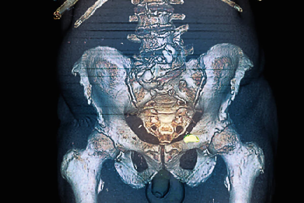 Metastatic prostate cancer. Coloured 3D computed tomography (CT) scan of a section through the pelvis of a 70-year-old male patient with prostate cancer that has metastasised (spread) to neighbouring bone tissue (green)