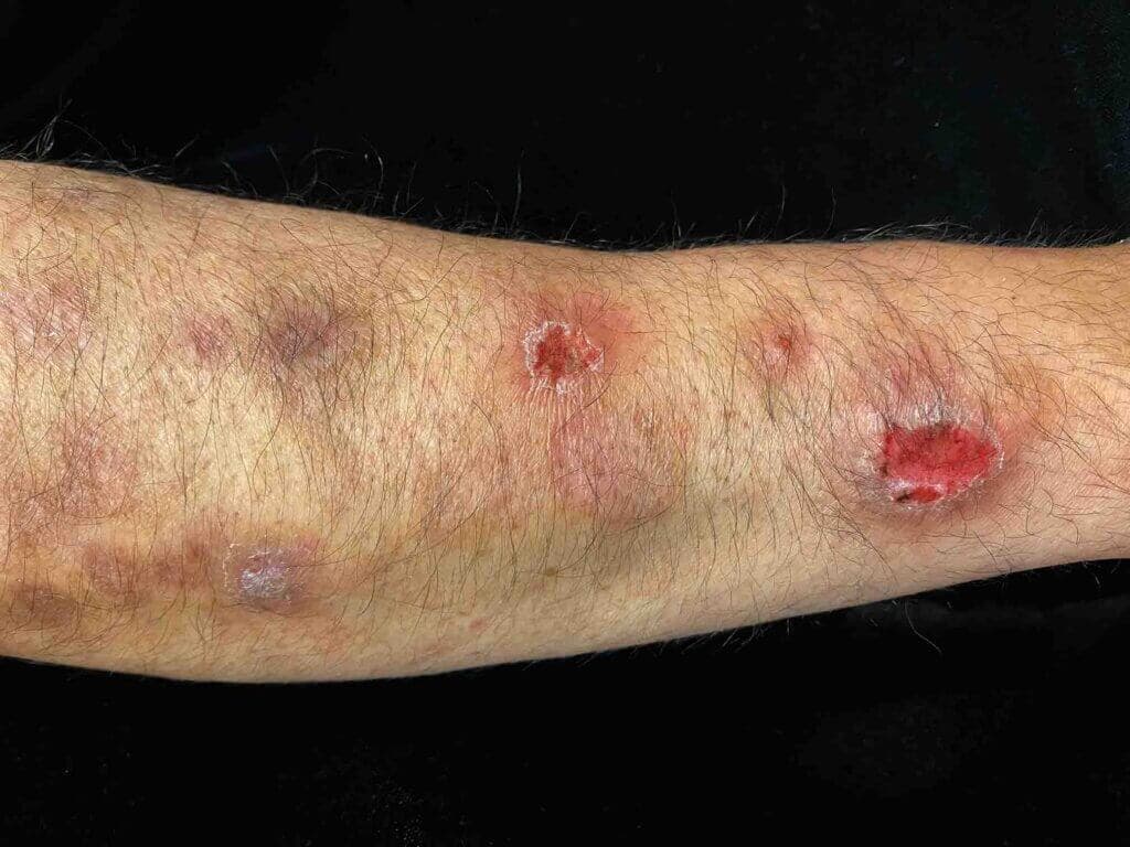 Skin picking disorder