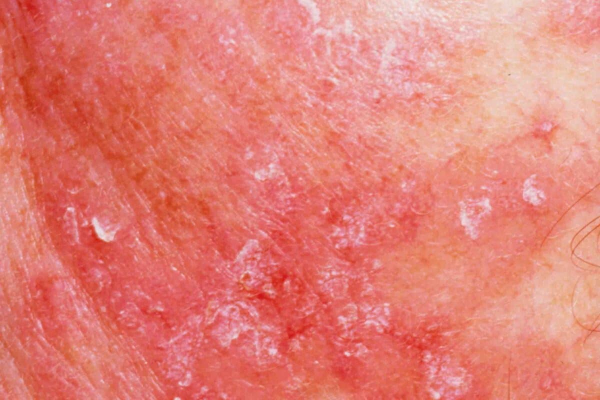 Hautläsionen eines Patienten mit systemischem Lupus erythematodes.