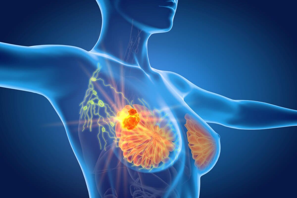 Auch bei bis zu zwei Makrometastasen der Sentinel-Lymphknoten bringt eine komplette Axilladissektion wenig.