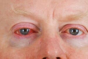 Bei der viralen Konjunktivitis treten häufig wässrige Sekrete auf.