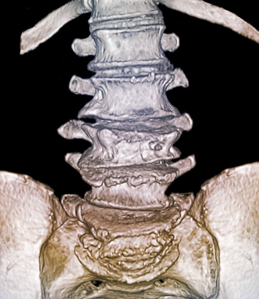 Bei der 71-jährigen GIOP-Patientin sieht man im 3D-CT-Scan eine Fraktur von L3.