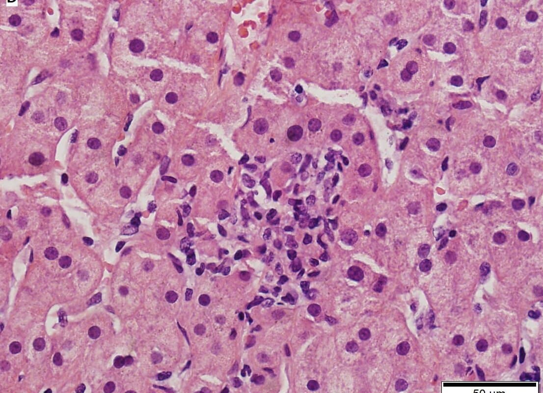 Bei einem DILI lassen das Ausmass der Nekrose und das Vorhandensein von Granulomen auf die Prognose schliessen.