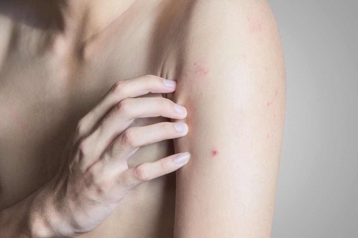 Bei Morgellons leiden Patienten unter der Vorstellung, unbelebte Objekte unter der Haut zu haben.