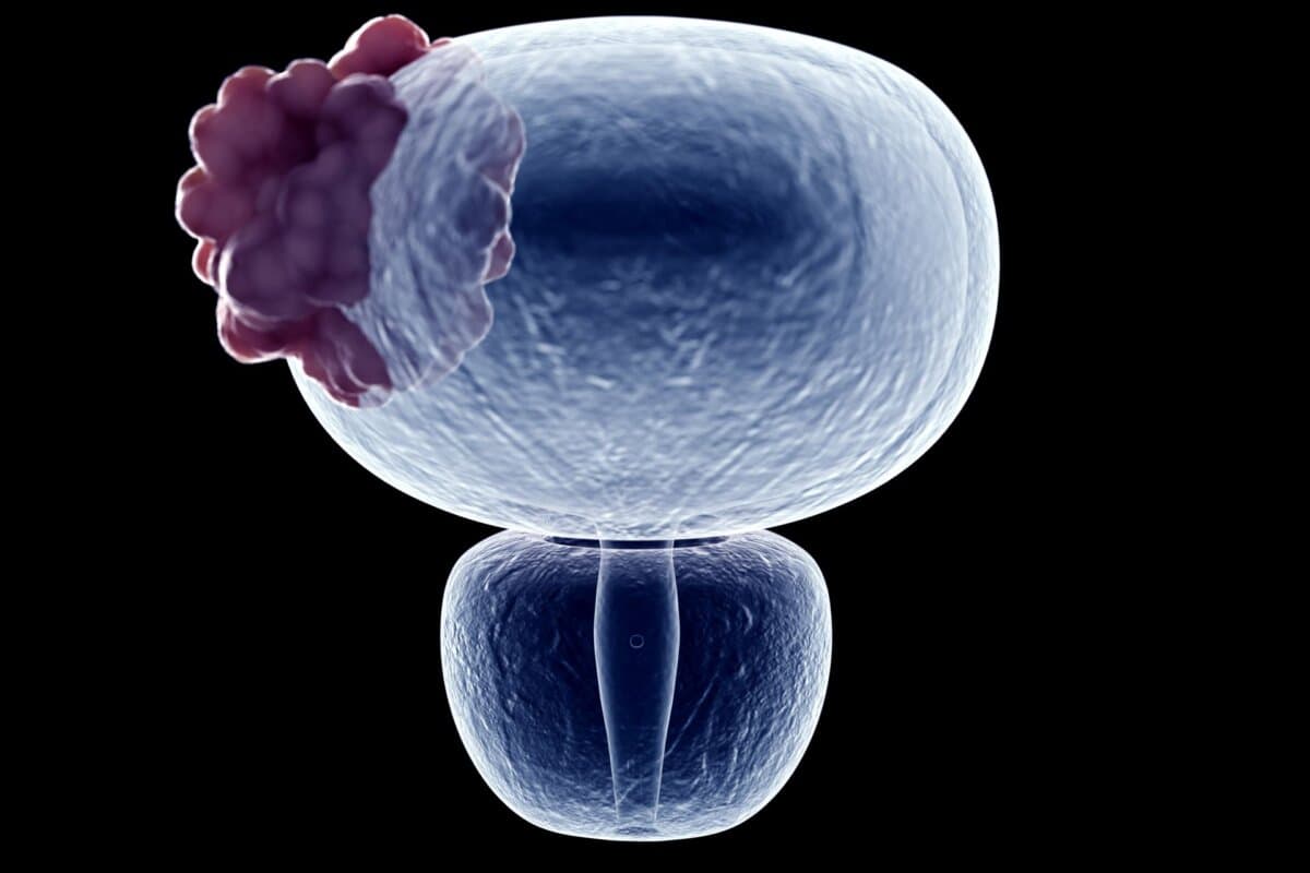 Enfortumab-vedotin plus Pembrolizumab könnte zum neuen Erstlinienstandard beim lokal fortgeschrittenen Urothelkarzinom werden.