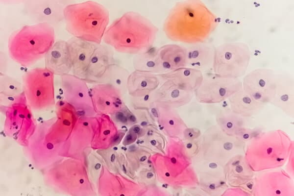 néoplasies associées à l’HP