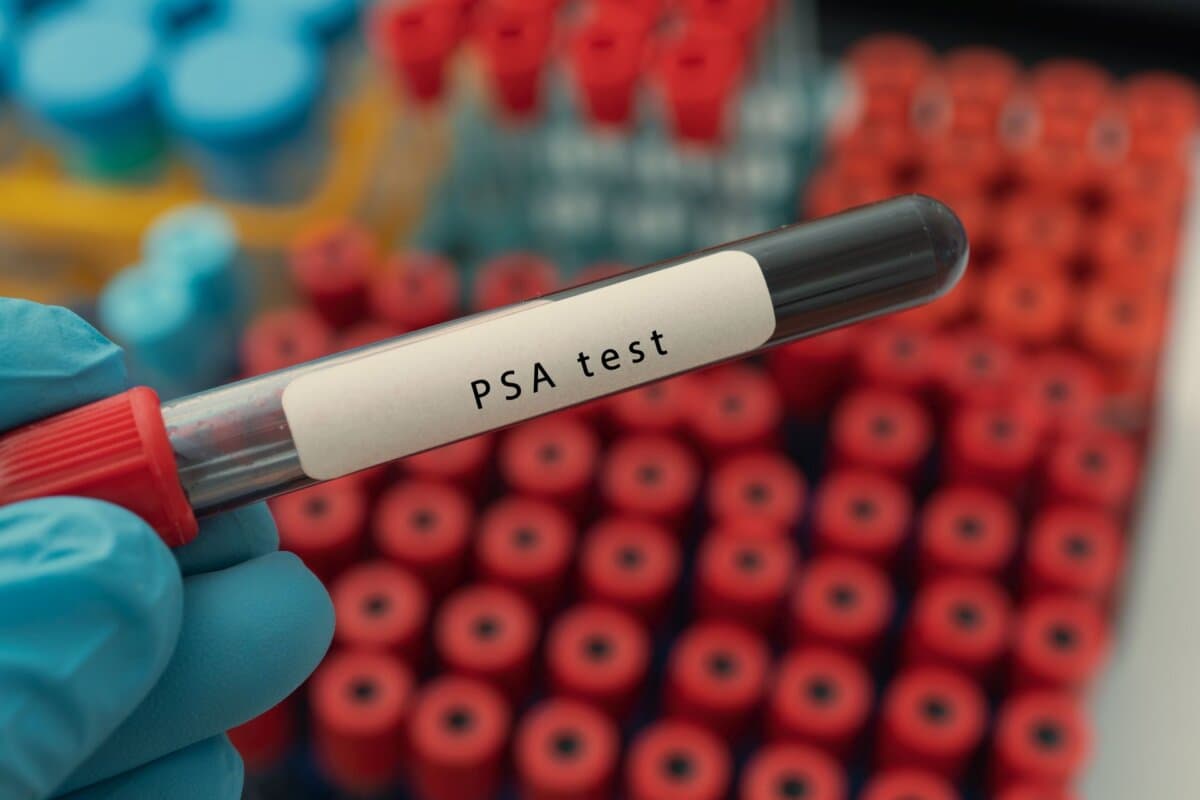 Allen neuen Optionen des Prostatakrebs-Screenings ist gemeinsam, dass sie die schädlichen Auswirkungen der Früherkennung begrenzen.