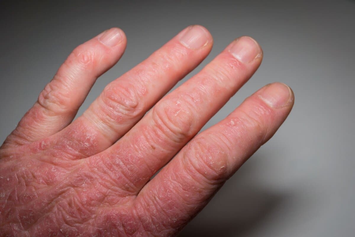 Aktualisierte EULAR-Empfehlungen beziehen Stellung zur medikamentösen Therapie der PsA.