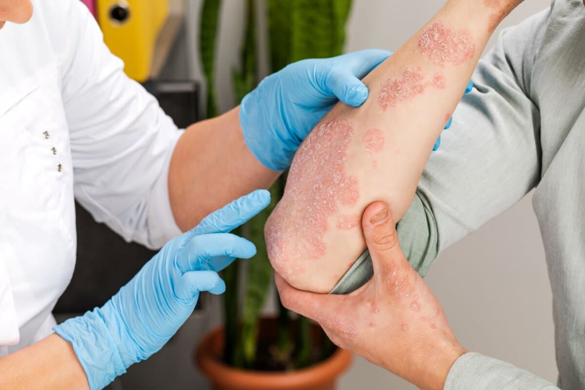 Die LC OCT kann beim Therapiemonitoring der Psoriasis helfen.