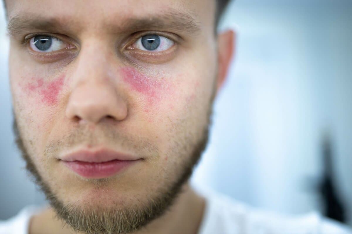 Infekte scheinen oft zu einem Lupus-Schub zu führen.