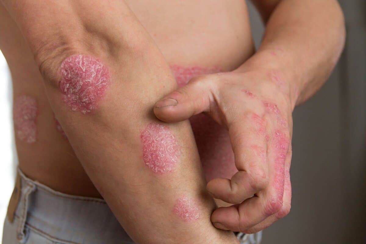 un comité d'experts a examiné le bimekizumab dans le psoriasis