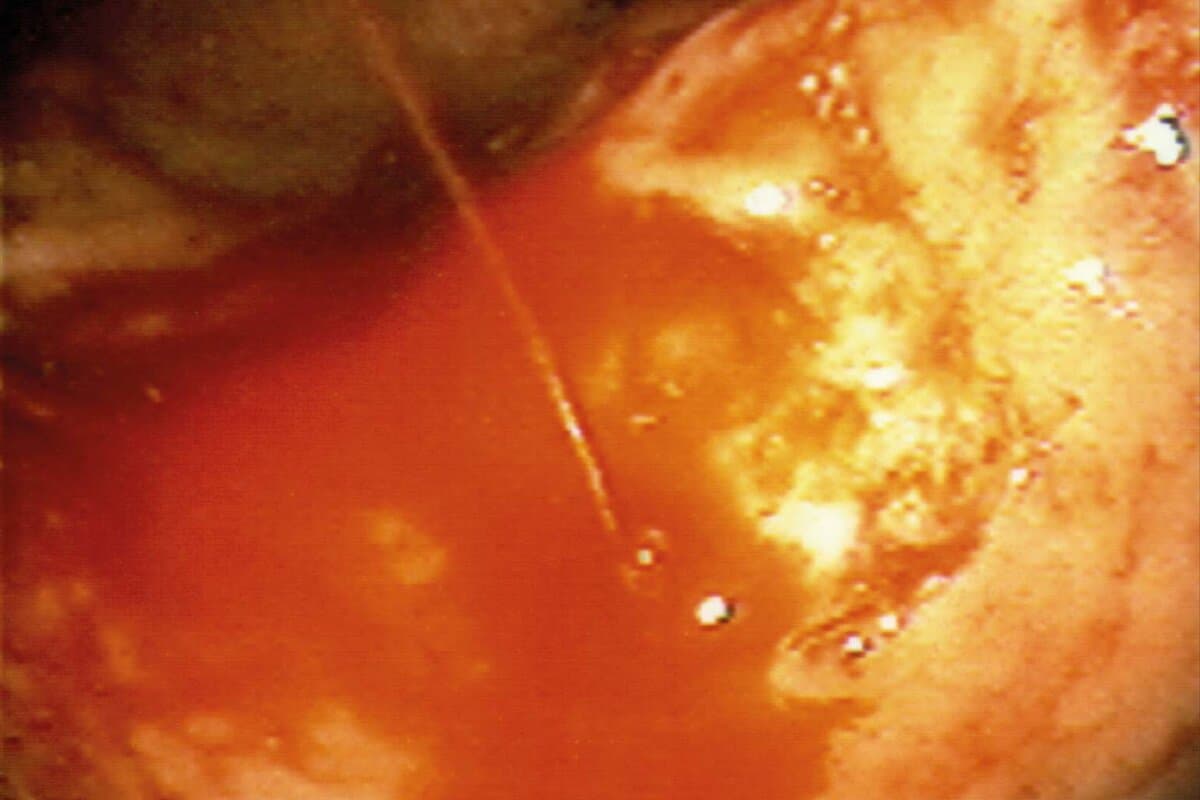 Bleeding stomach ulcer. Gastroscope (endoscope) view of a bleeding gastric (peptic) ulcer of a 71 year-old male patient. The bleeding was controlled by using an probe,which passes an electric current through the bleeding vessel to seal it (electrocautery). Ulcers are caused by excessive stomach acid (digestive juice). This acid,often combined with excess alcohol and caffeine,attacks the stomach wa
