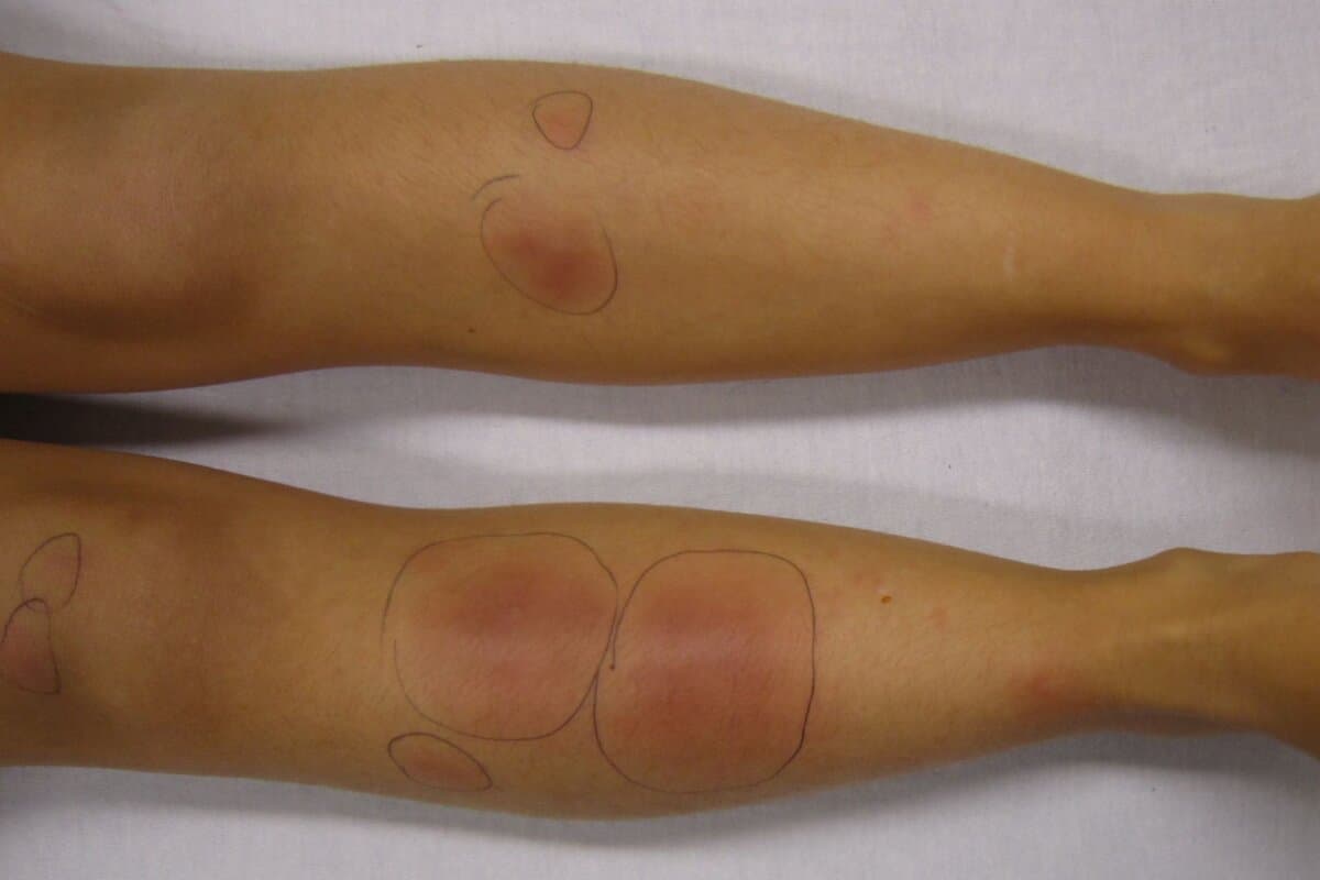 Beim Erythema nodosum treten schmerzhafte Schwellungen an den Schienbeinen auf.