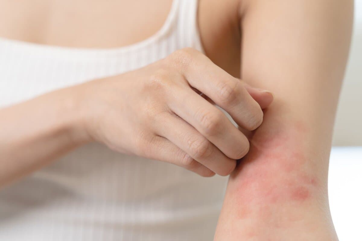 Nemolizumab verbesserte in zwei randomisierten Studien Juckreiz und Krankheitsschwere bei der atopischen Dermatitis.
