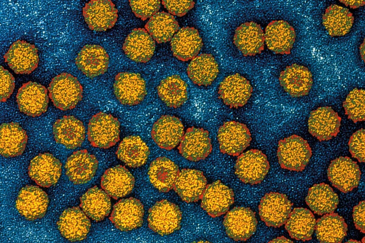 Viren - Parvoviren Parvovirus B19 (Erythrovirus) - Auslöser der Ringelröteln. Parvoviren kommen bei Mensch und Tier vor, das einzige f. d. Mensch bedeutende ist das Virus B19. Durchmesser 20-24 nm. Dieses Virus kann sich nur in den Vorläuferzellen der Erythrozyten im Knochenmark vermehren. Inkubationszeit 5-7 Tage, grippales Krankheitsbild, Viren im Blut nachweisbar, vermehrt unreife Erythrozyten