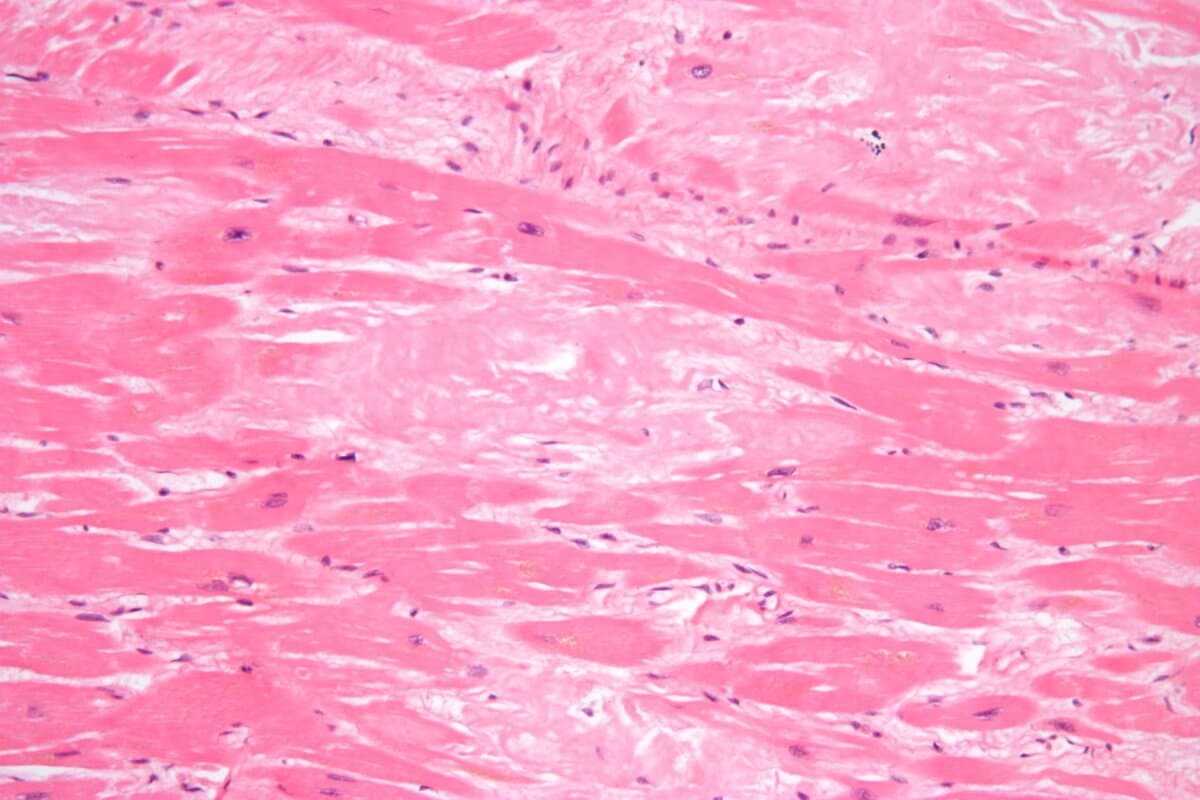 Bei der ATTR-Kardiomyopathie lagert sich fehlgefaltetes Protein (Amyloid, hellrosa) im Herzen ab.