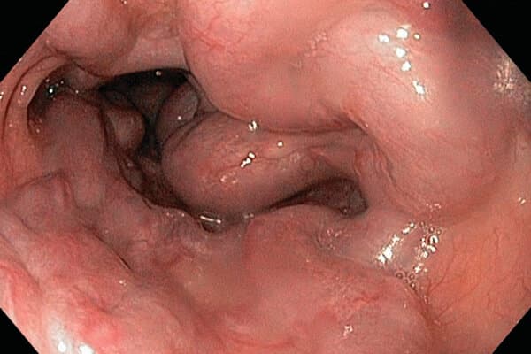 Varices de degré IV avec obstruction quasi totale de la lumière et risque accru d’hémorragie.
