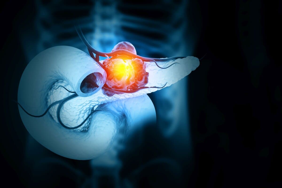 De nouvelles stratégies aident au dépistage précoce du cancer du pancréas