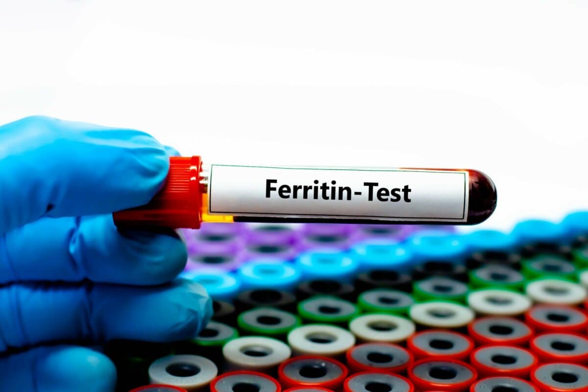 Ein erhöhtes Serumferritin kann bei MASLD-Patienten auf ein erhöhtes Komplikationsrisiko hindeuten.