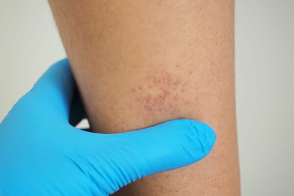 Gros plan sur une jambe avec des points rouges dus à une thrombocytopénie.