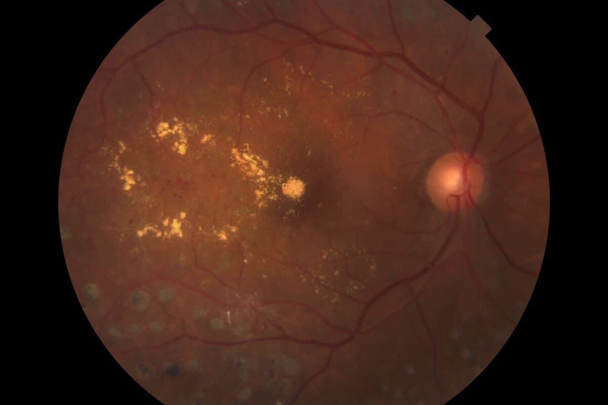 Le diabète peut entraîner des atteintes oculaires telles que cataracte, glaucome et rétinopathie/maculopathie diabétique