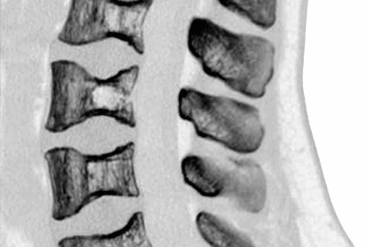 Sickle Cell Osteopathy,CT Scan