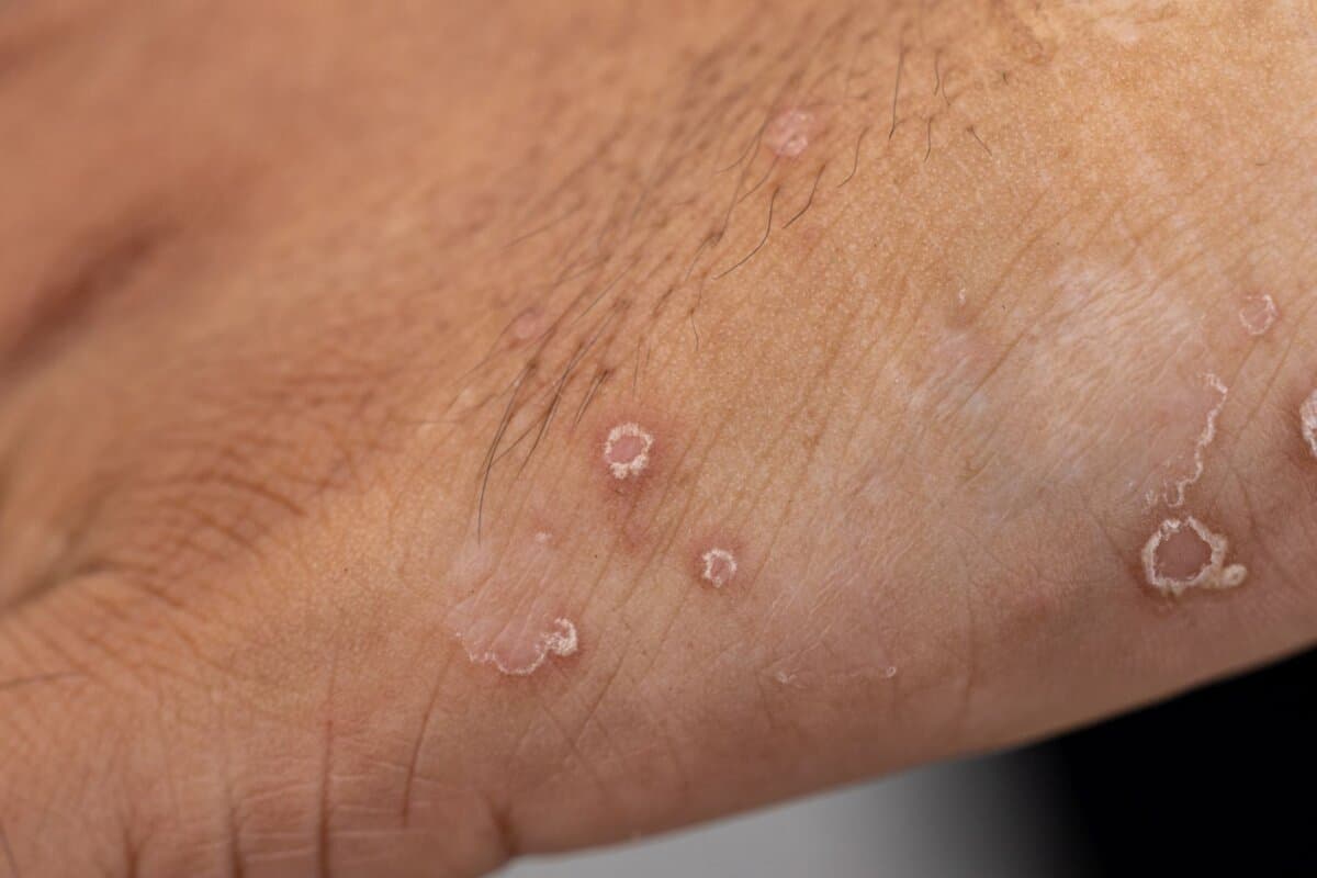 Der Immunmodulator Iberdomid könnte vor allem für subakute und chronische kutane Lupus-Verlaufsformen nützlich sein.