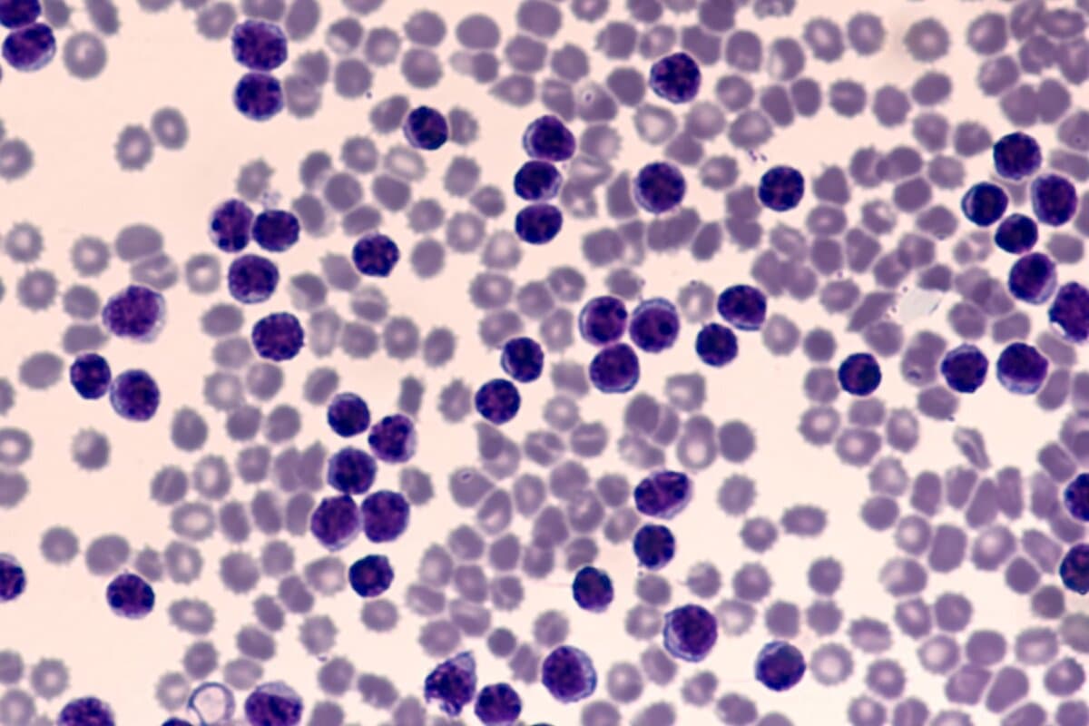 L'Ibrutinib en monothérapie montre un bénéfice durable sur la PFS et l'OS chez les patients CLL/SLL non prétraités