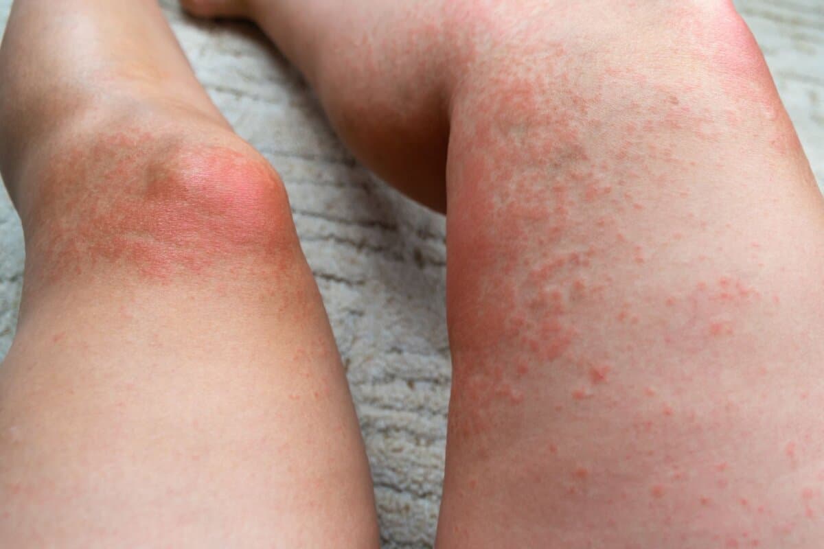 Lichtdermatosen wie die polymorphe Lichtdermatose zeigen sich meist in lichtexponierten Bereichen.