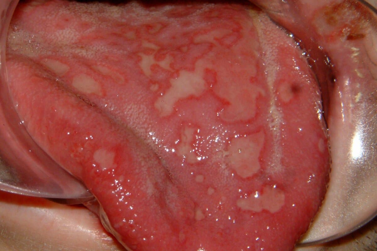 Manifestation d'un érythème exsudatif multiforme sur la langue