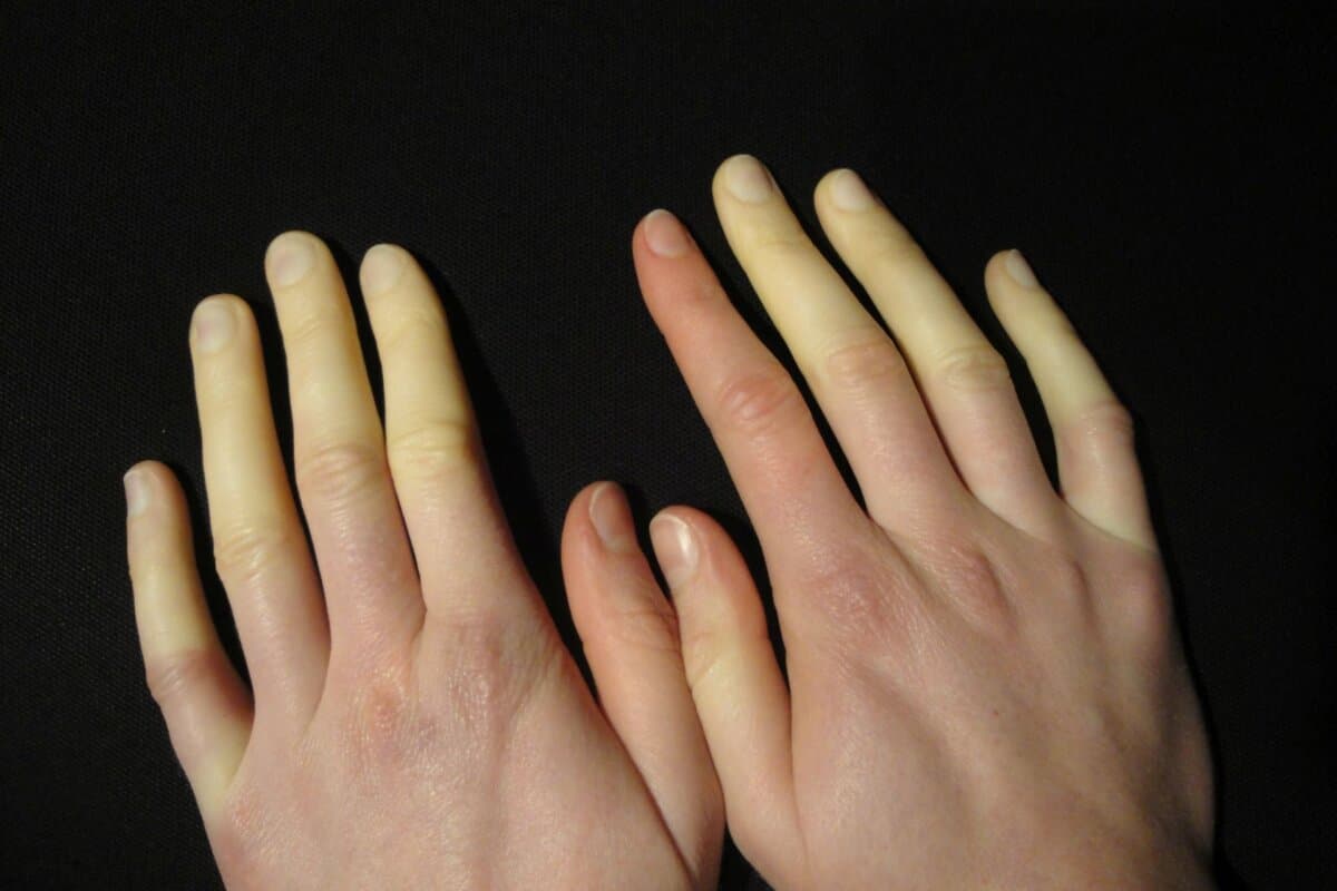 Steckt hinter einem Raynaud-Syndrom eine Sklerodermie? Das kann bereits eine Nagelfalz-Dermoskopie relativ sicher beurteilen.