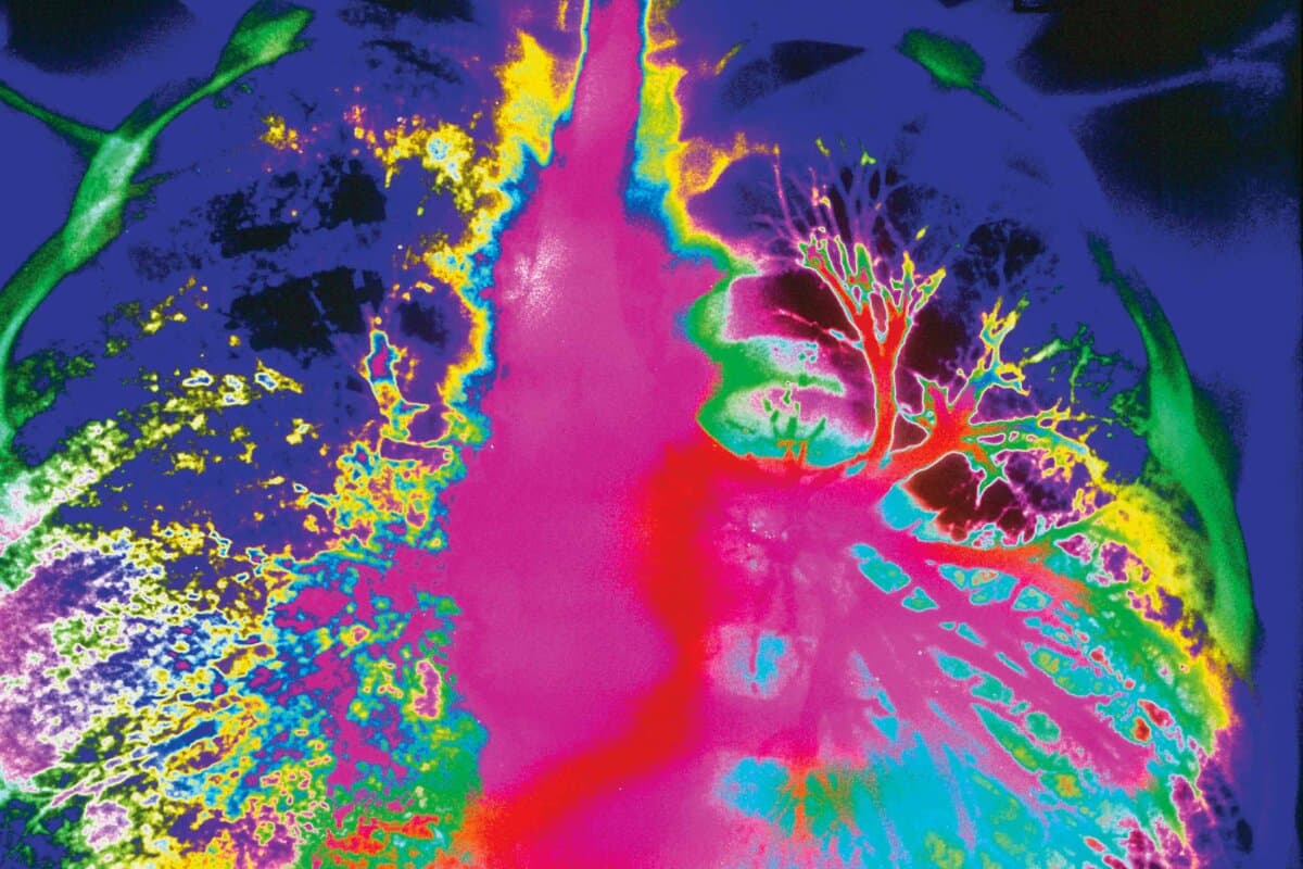 Bronchiectasis. Computer enhanced bronchogram X- ray of the human lungs showing bronchiectasis. Bronchiectasis is a lung disorder in which the bronchi and bronchioles (airways of the lungs) are distorted and damaged. Here,the lung at right has a normal bronchial tree of airways (pink branching structures); the affected lung at left shows an almost complete lack of structure. Ribs appear dark blue
