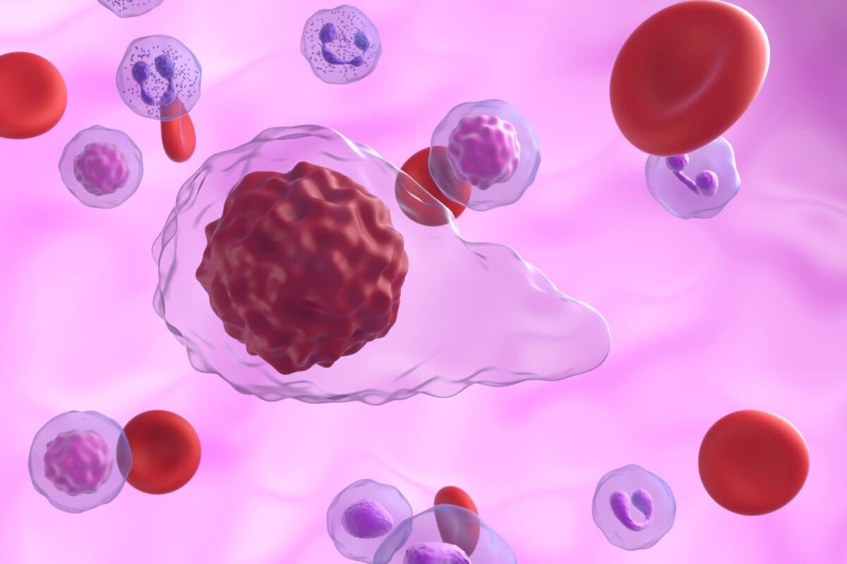 Erstmals stellt sich die Frage nach dem richtigen JAK-Inhibitor bei Myelofibrose.
