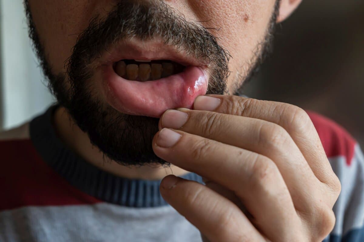 Aphthen im Mund sind oft erste Anzeichen für einen Morbus Behçet.